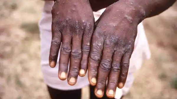 This Country Becomes First In The World To Introduce Compulsory Monkeypox  Quarantine | Mint