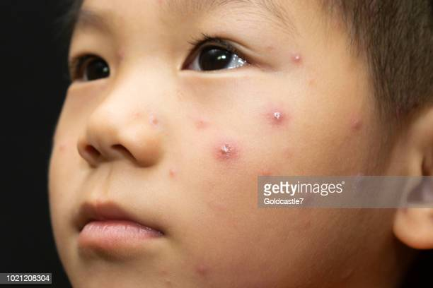 34 Chickenpox Asian Photos and Premium High Res Pictures - Getty Images